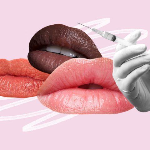 lip flip lip filler injections