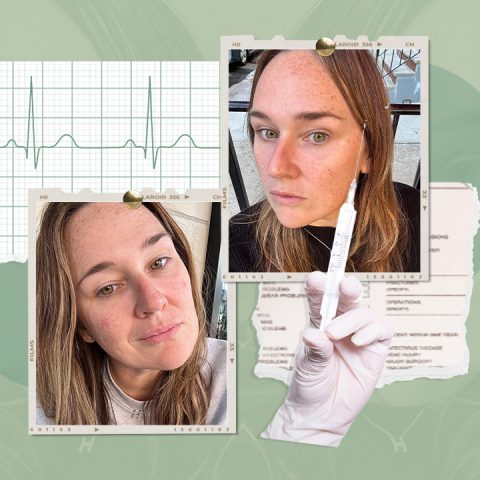 undereye filler for tired eyes