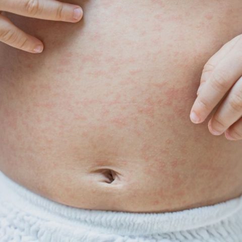 measles outbreak